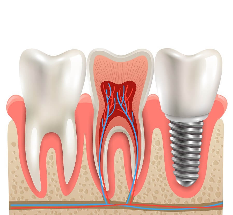 RCT vs Implants