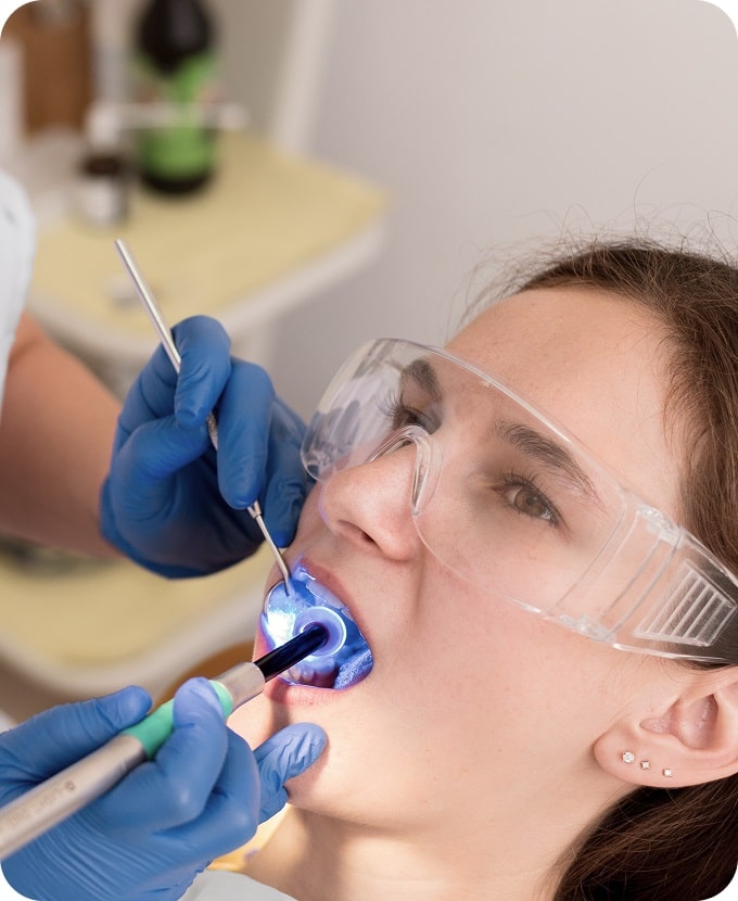 Dental Fillings