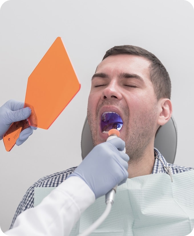 Dental Fillings