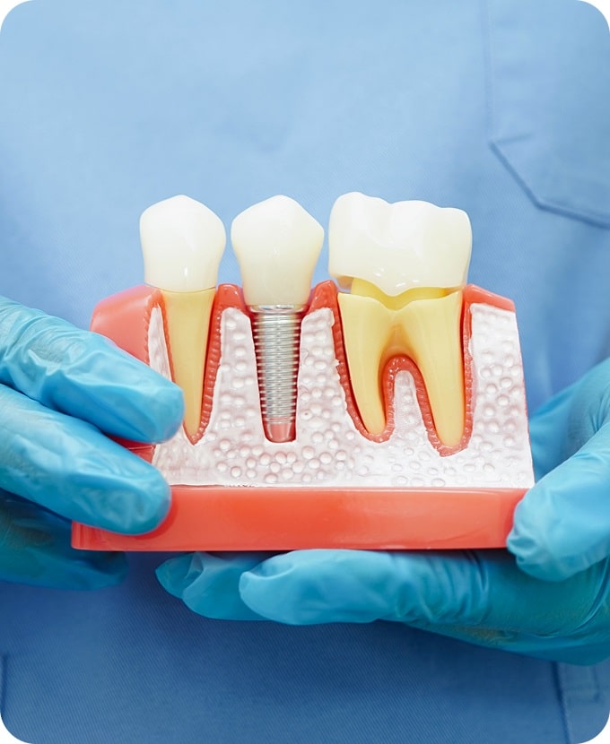 Single Tooth Implants