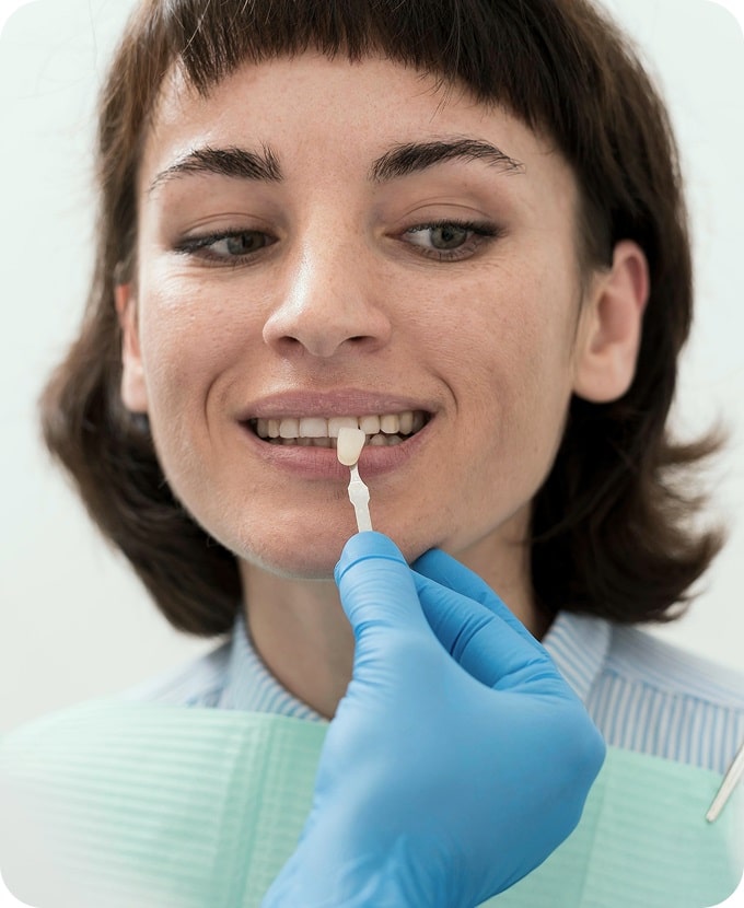 Veneers