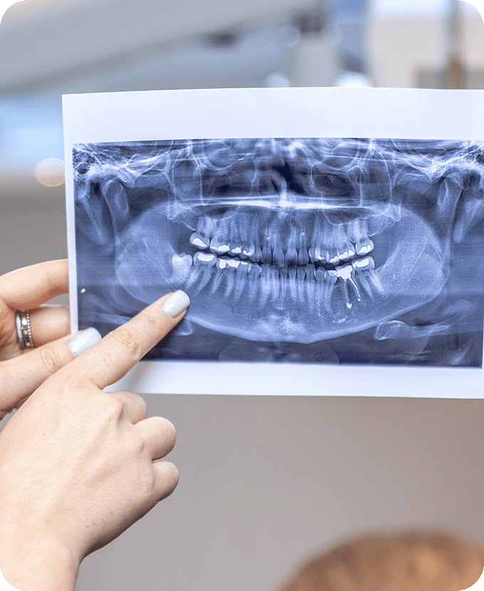 Wisdom Teeth Removal